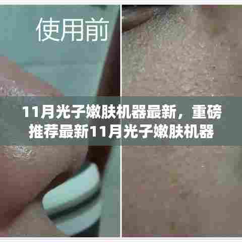 最新11月光子嫩肤机器,打造无瑕美肌的秘密武器重磅推荐!